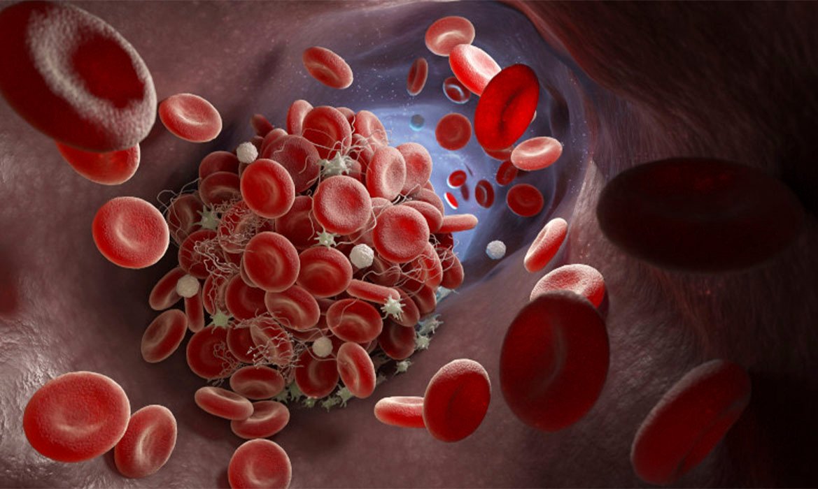 La enfermedad silenciosa que puede provocar trombos y complicaciones graves